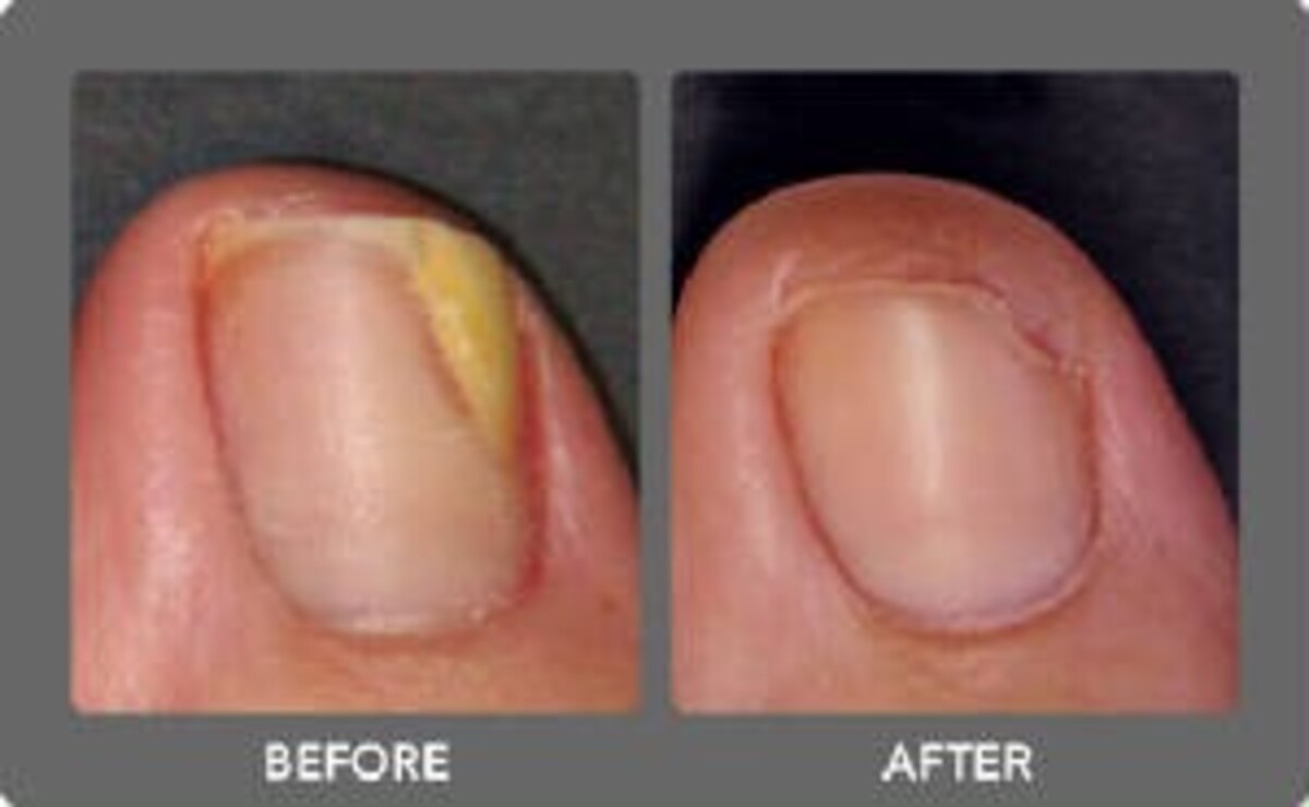 Management of nail infections - DailyExcelsior