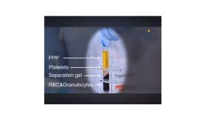 PRP Platelet Rich Plasma