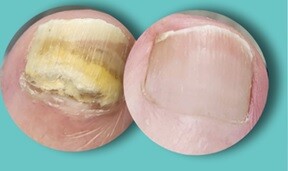 Toenail fungus