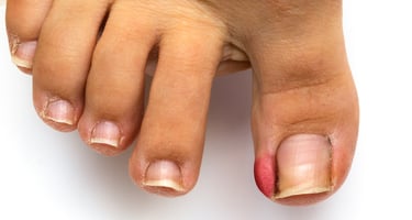 Ingrown toenail Clermont Florida