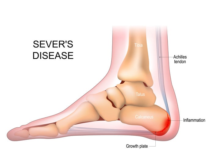 Sever's Disease