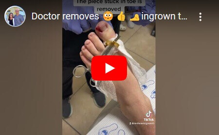 Ingrown toenail Podiatrist