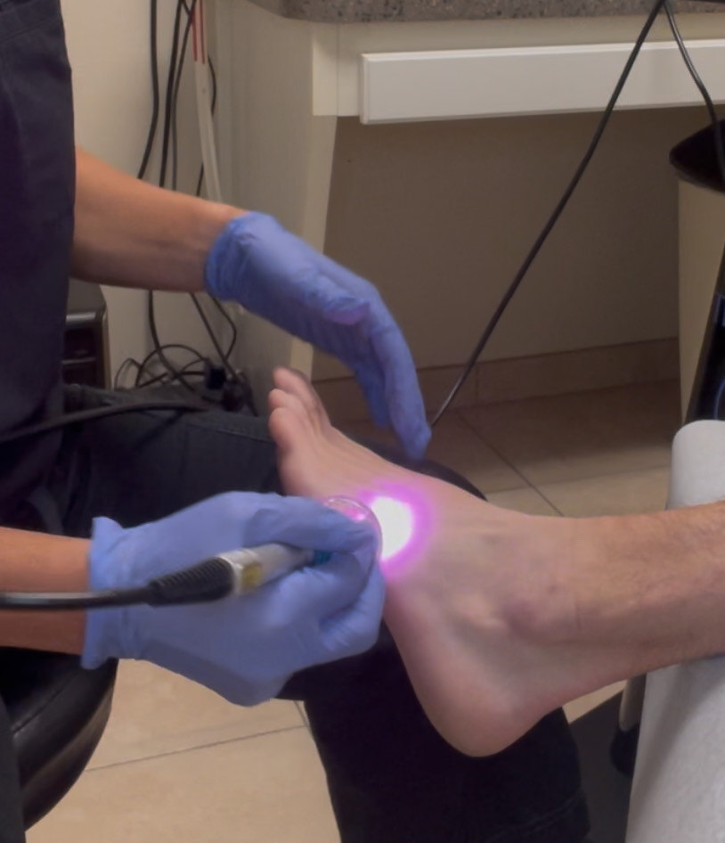 Laser for Foot Arthritis