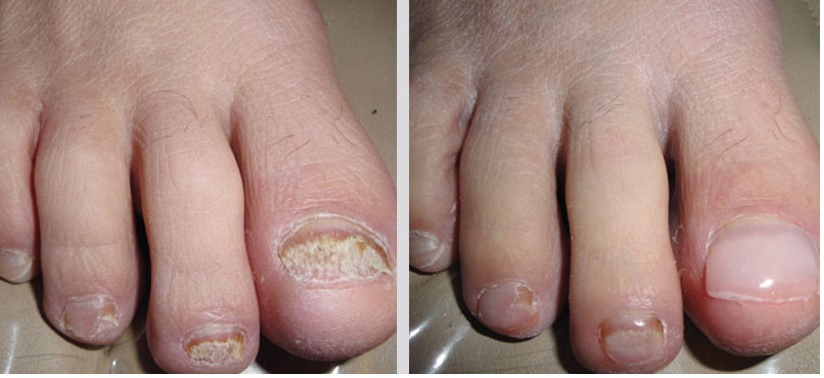 before and after keryflex before and after keryflex