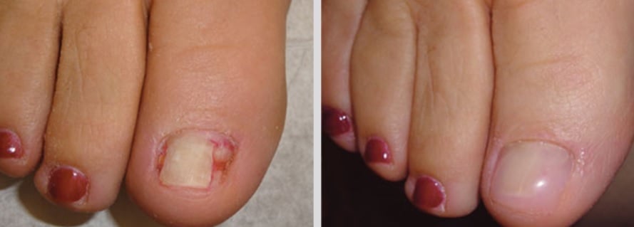 before and after keryflex2 before and after keryflex2