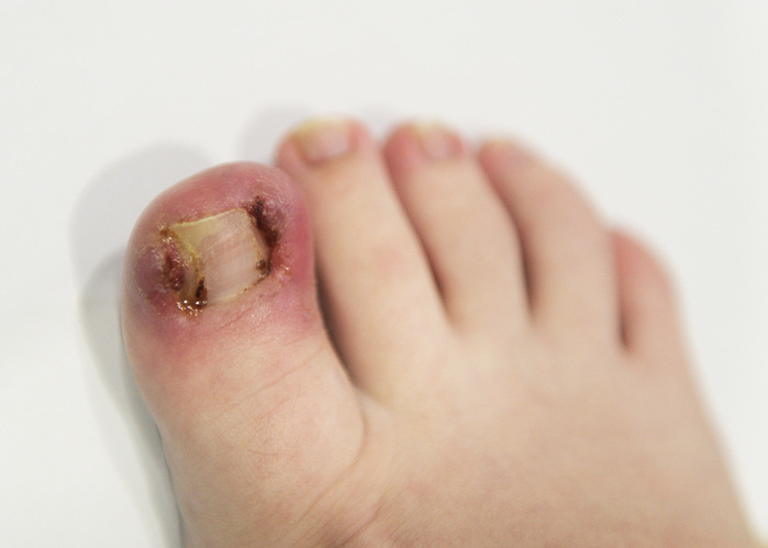 Ingrown Toenail Procedure