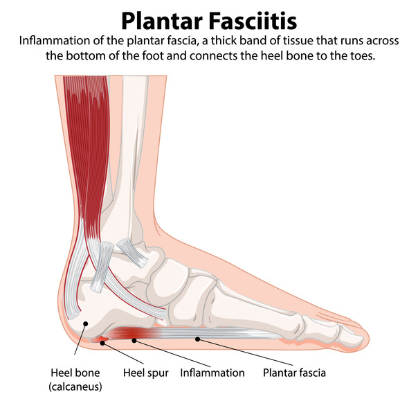 Plantar fasciitis