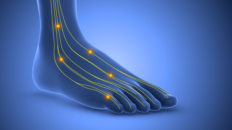 Neuropathy foot