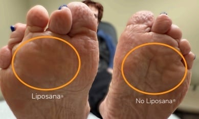 liposana6