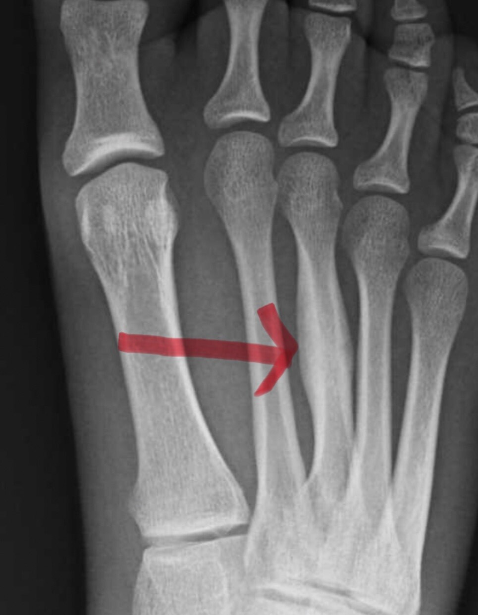 stress fracture foot